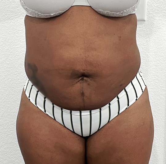 Liposuction 360 with Fat Transfer to the Buttocks (Brazilian Butt
